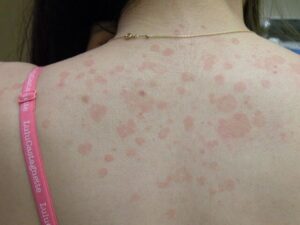 Pityriasis versicolor