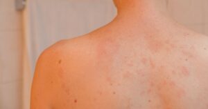Pityriasis rosé de Gibert _ qu'est-ce que c'est _