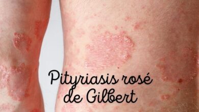 Pityriasis rosé de Gibert