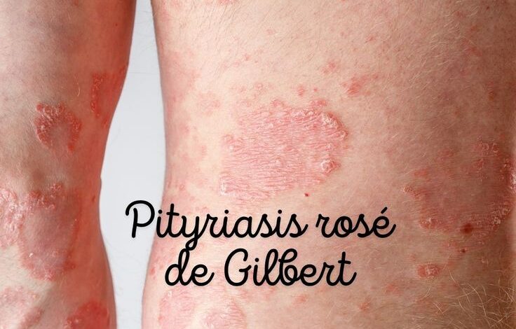 Pityriasis rosé de Gibert