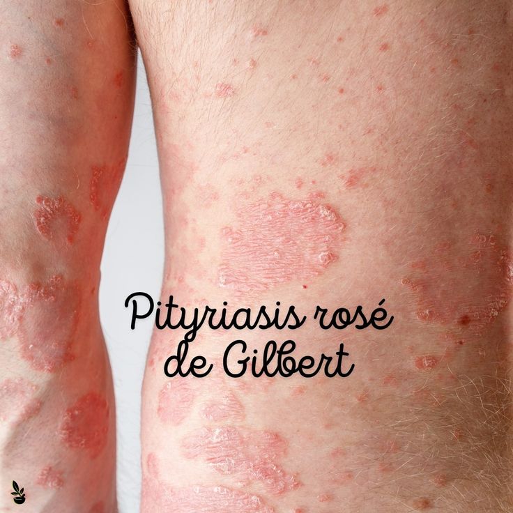 Pityriasis rosé de Gibert