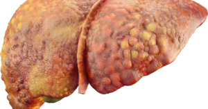 Cirrhose du foie