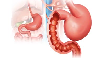 sleeve gastrectomie