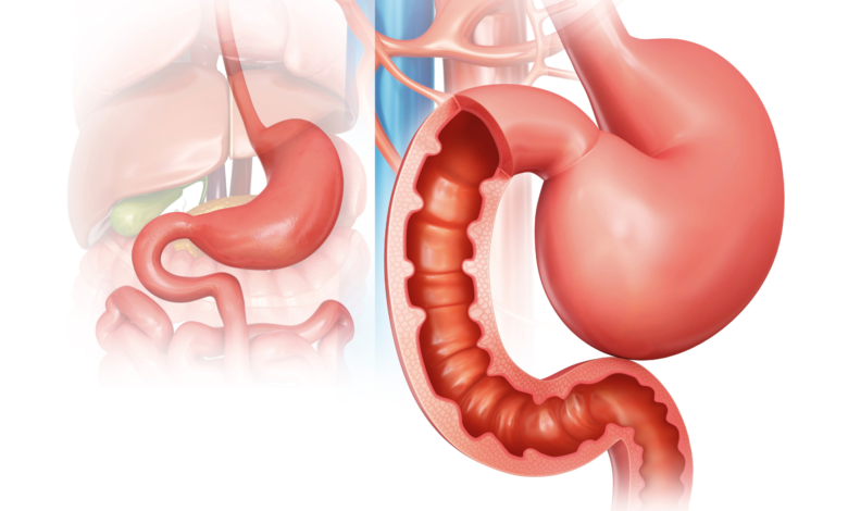 sleeve gastrectomie
