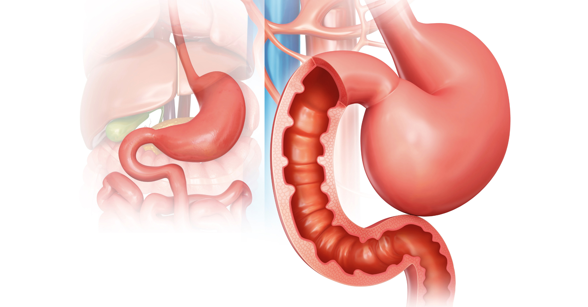 sleeve gastrectomie