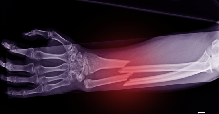Fracture de fatigue