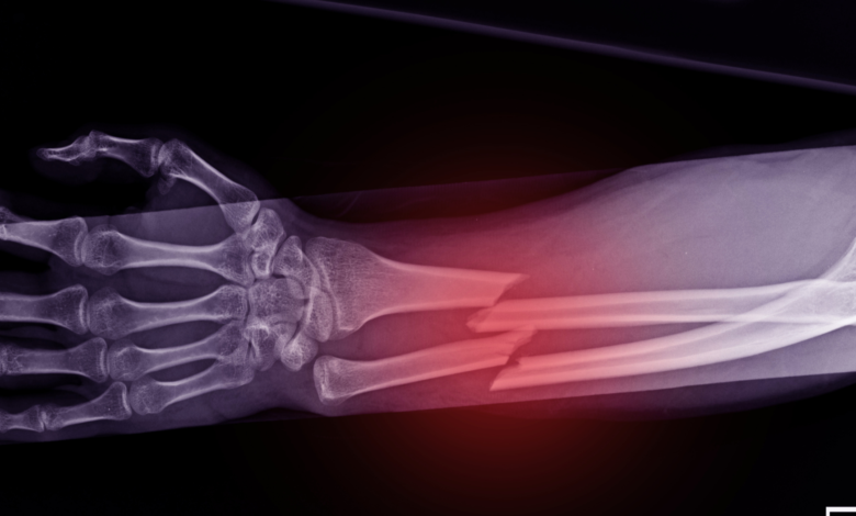 Fracture de fatigue