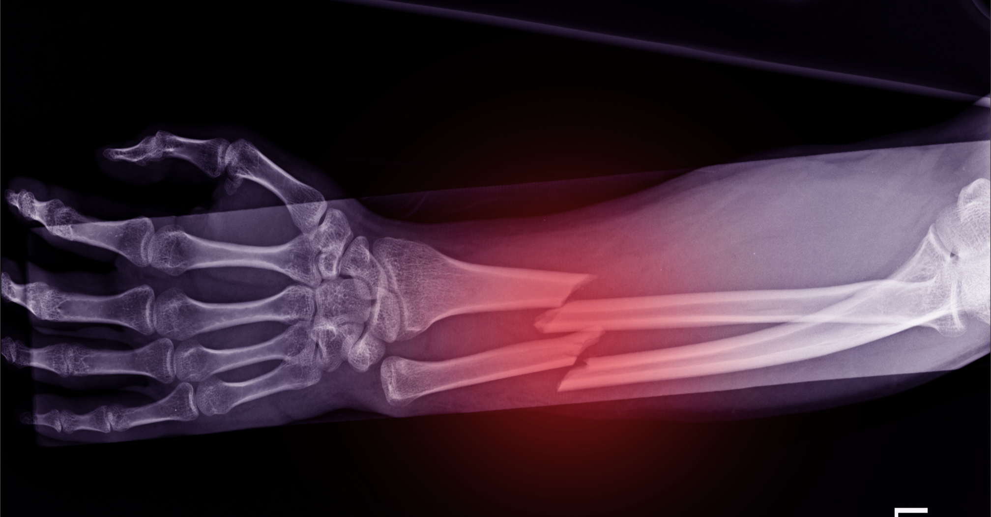 Fracture de fatigue