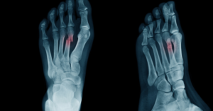 Fracture de fatigue