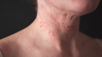 eczéma visage