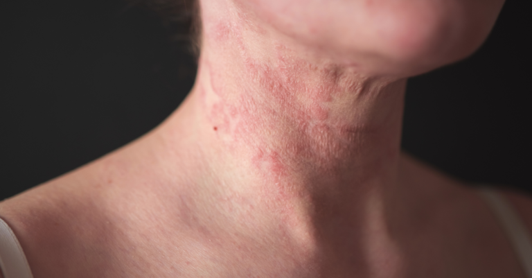 eczéma visage