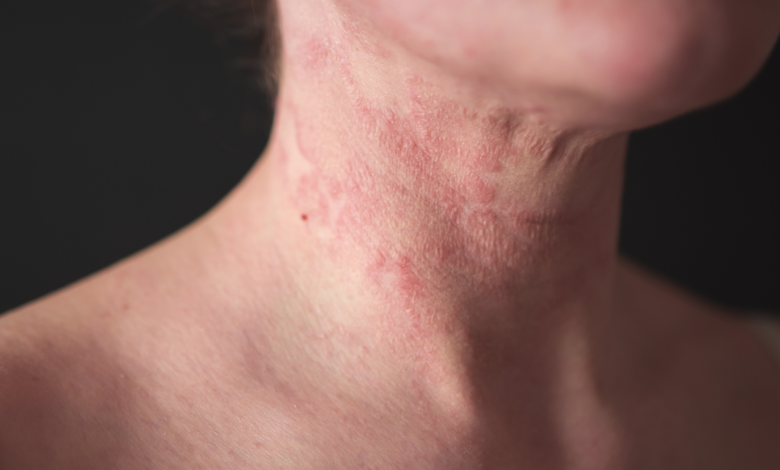 eczéma visage
