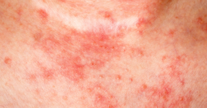 eczéma visage