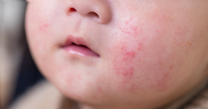eczéma visage