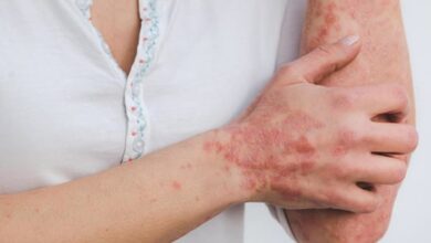 Dermatite atopique chez l'adulte