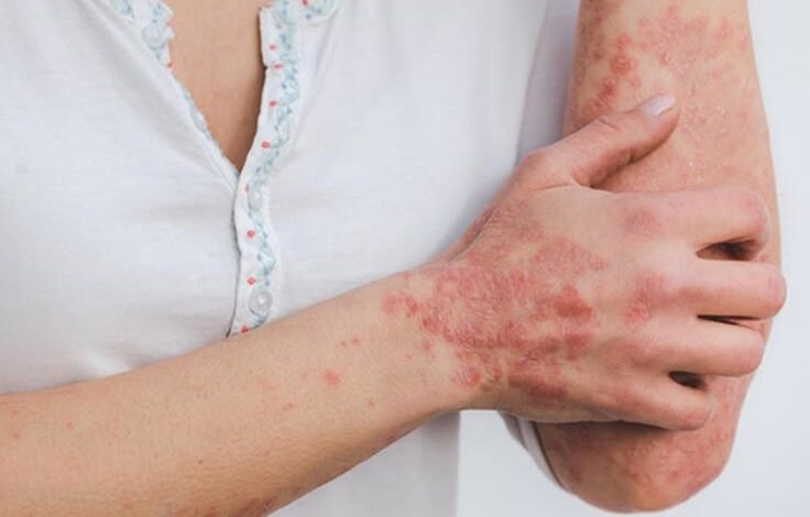 Dermatite atopique chez l'adulte