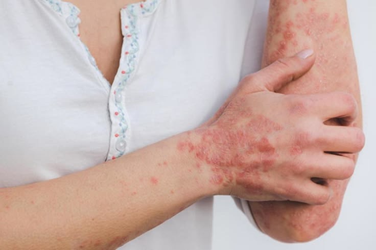 Dermatite atopique chez l'adulte