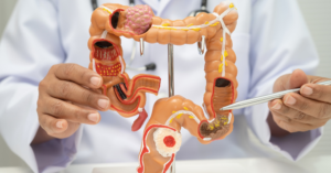 comment meurt-on d'un cancer du colon