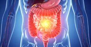 comment meurt-on d'un cancer du colon
