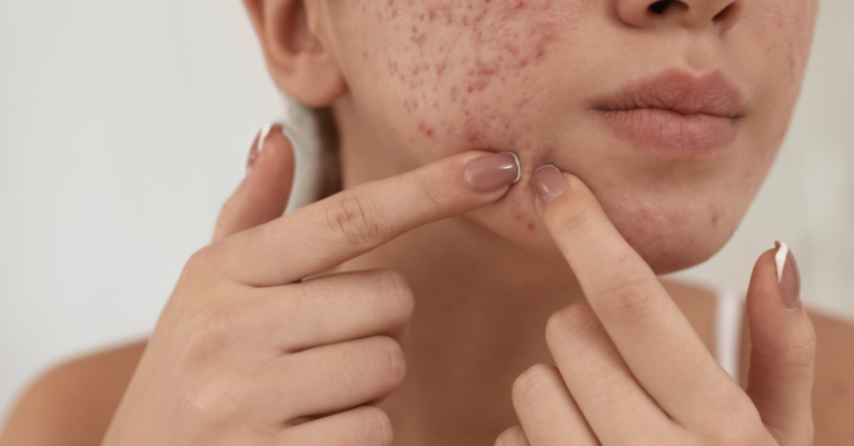 Masque de grossesse : tout savoir sur ces taches brunes du visage masque de grossesse