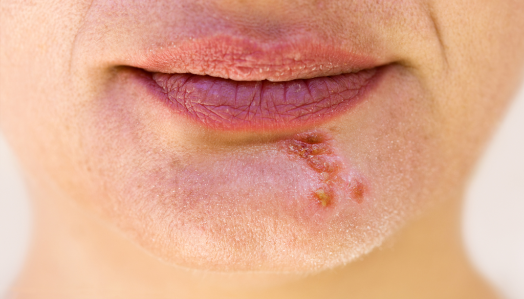 herpès labial