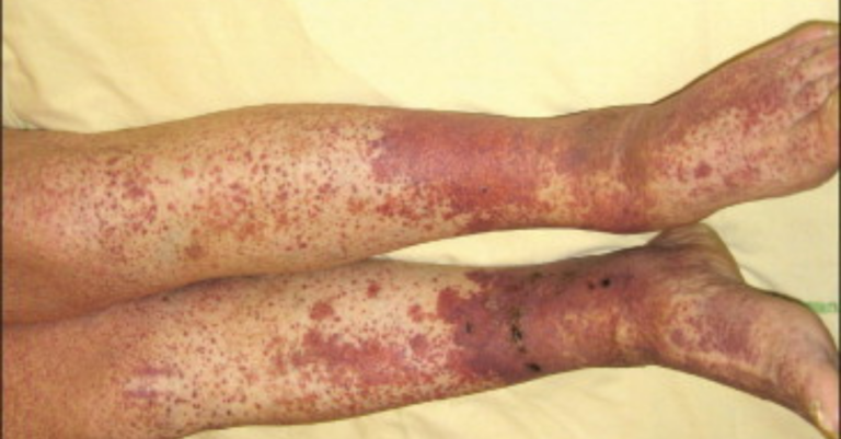 Purpura : pourquoi ces taches rouges apparaissent-elles sur la peau ? Purpura