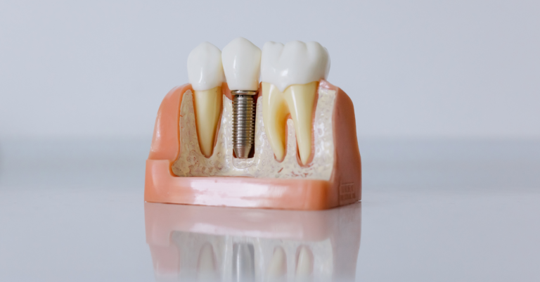 Combien de séances pour un implant dentaire : le parcours complet du patient combien de séances pour un implant dentaire