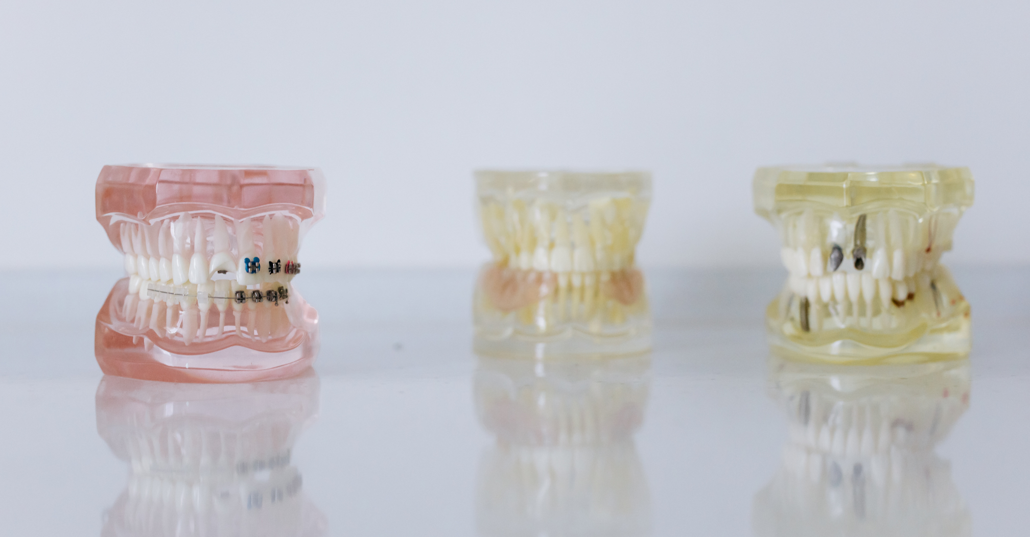 combien de séances pour un implant dentaire